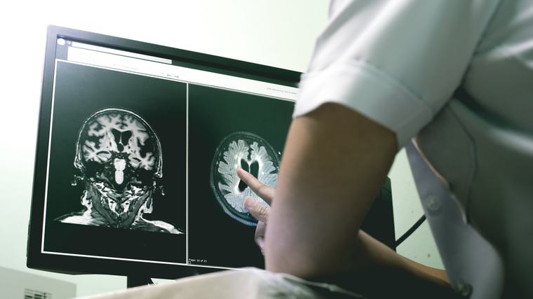 Así actúa y nos prepara el cerebro para las sorpresas
